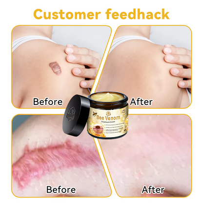 🍯Turonu™Aussie Bee Venom Skin Treatment Cream（✅TGA-CERTIFIED）